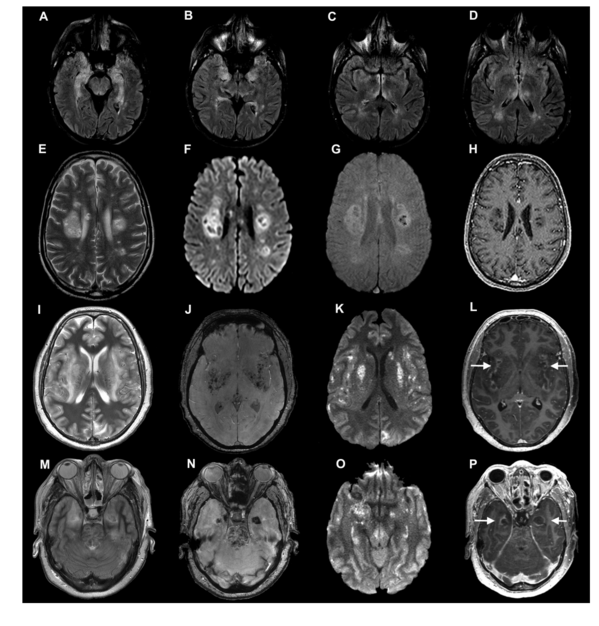 The emerging spectrum of COVID-19 neurology: clinical, radiological and laboratory findings.figure1.png