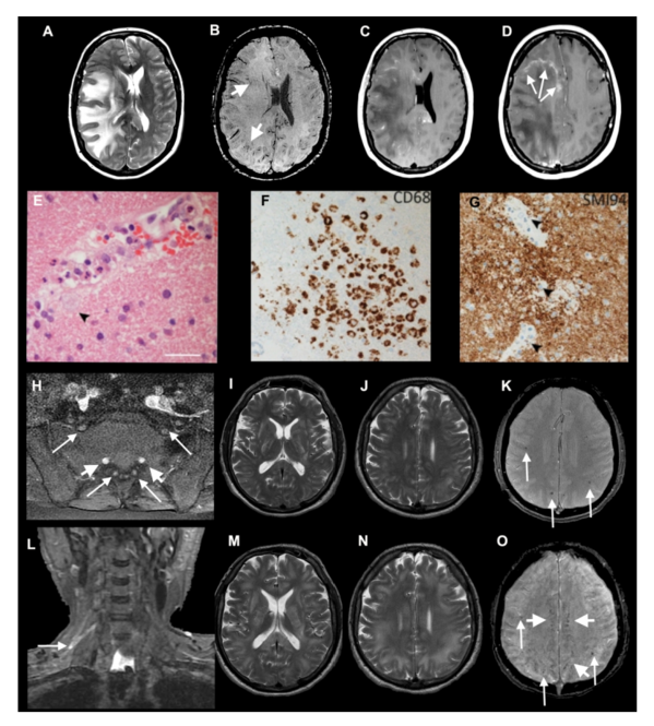 The emerging spectrum of COVID-19 neurology: clinical, radiological and laboratory findings.figure2.png