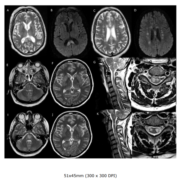 The emerging spectrum of COVID-19 neurology: clinical, radiological and laboratory findings.figure4.png
